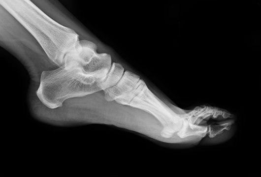 Foot x-ray image for use in treating patients. Patients with foot-related symptoms.