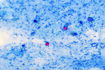 Cryptosporidium parvum protozoa positive (red sphere shape) in human stool smear, oocyst stage,...