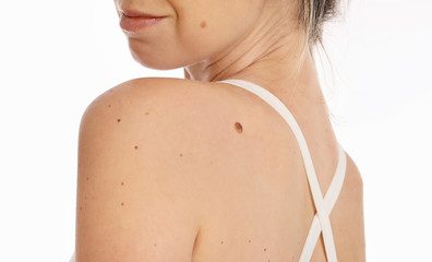 Woman with birthmark on her back, skin. Checking benign moles. Skin tags removal