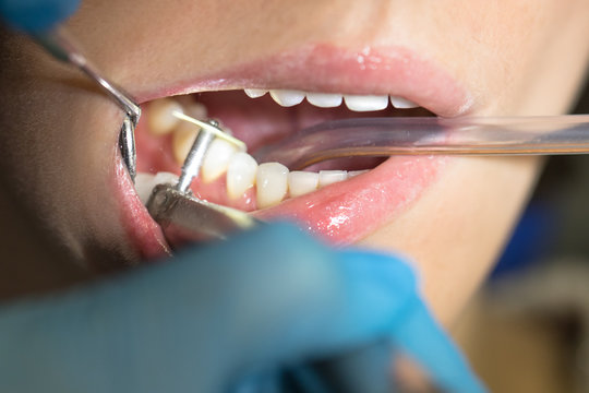 Close up of dental polishing treatment from dental deposit and odontolith in dental clinic. Dentist making professional teeth cleaning for woman, soft focus