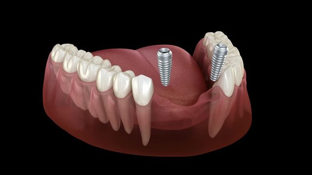 Frontal teeth bridge supported by implants. Medically accurate 3D animation of dental concept