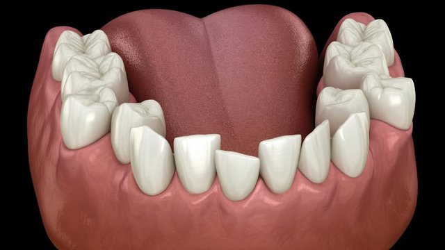 Overcrowding dental occlusion ( Malocclusion of teeth ). Medically accurate tooth 3D animation