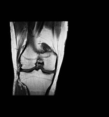 Magmetic resonance imaging (MRI-scan) of knee, Knee arthritis (Osteoarthritis)