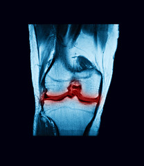 Magmetic resonance imaging (MRI-scan) of knee, Knee arthritis (Osteoarthritis), coronal view