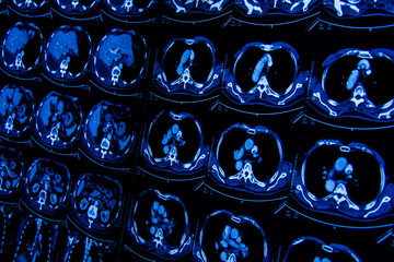 Computerized x-ray image of the patient's body for treatment.research in medicine. CT scan of the...