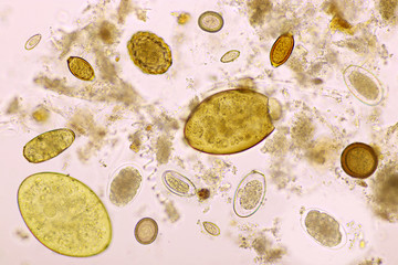 Mix of helminths or parasitic worm in human stool, analyze by microscope, original magnification...
