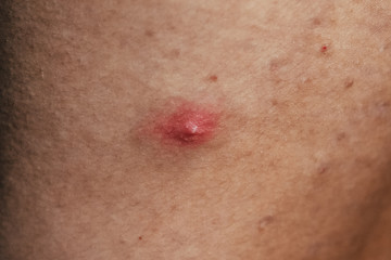 Big red pimple on a man's back
