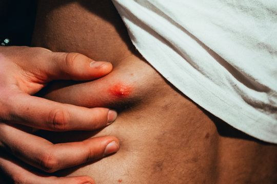 Big red pimple on a man's back