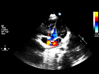 Screen of echocardiography (ultrasound) machine.