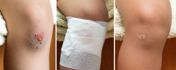 Knee wound treatment, healing stages close up