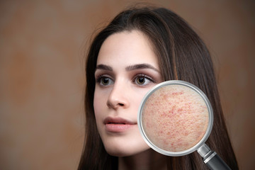 Young woman suffering from skin irritation close up view