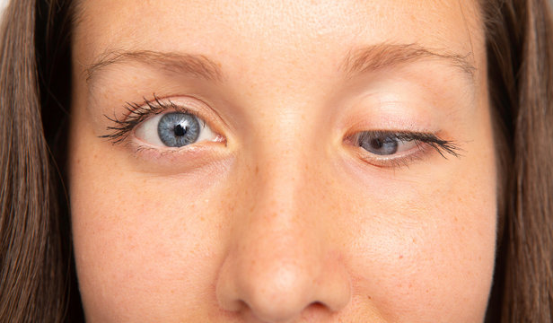 Young woman with strabismus, ophthalmic problem