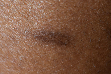 Macro view of birthmark on human skin