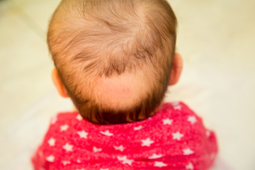 Bald spot on the back of the head of a small baby