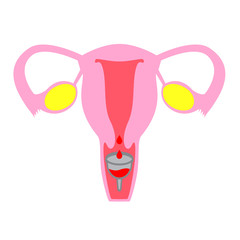 Female internal organ, uterus with menstrual cup. Flat simple vector illustration isolated on white background.