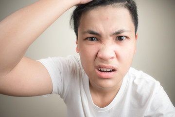 Close-up of acne on the forehead of young Asian people.