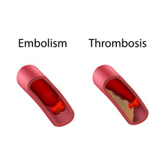 Embolism and thrombosis, comparison. Medical anatomy illustration.