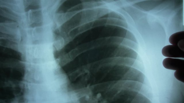 Clinician Examining X-Ray Image Of Patient's Spine and Chest POV