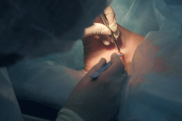 Surgeon makes an incision with scalpel on leg on ankle to remove joint hygroma in operating room in...