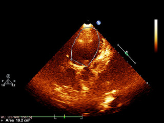 Screen of echocardiography (ultrasound) machine.