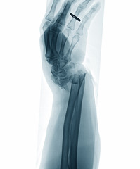 X-ray image of wrist joint, lateral view, showing distal ulnar and radius fractures and dislocation