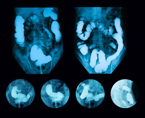 Lower gastrointestinal (GI) tract radiography (lower GI or barium enema), an x-ray examination of...