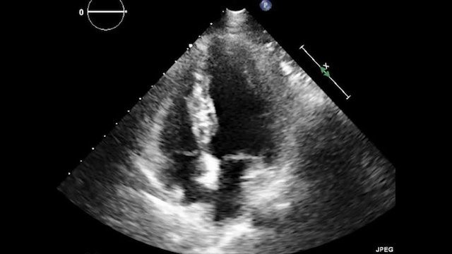 Transesophageal Ultrasound Echocardiography.