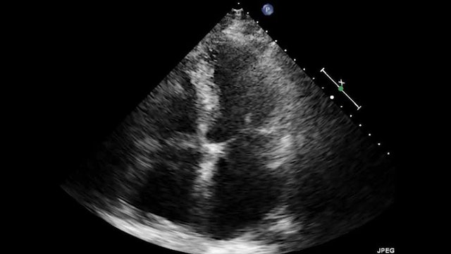 Transesophageal Ultrasound Echocardiography.
