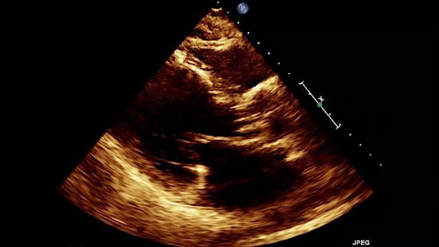 Transesophageal Ultrasound Echocardiography.