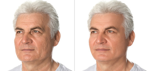 Mature man before and after plastic surgery on white background