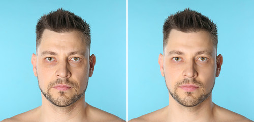 Man before and after plastic surgery on blue background