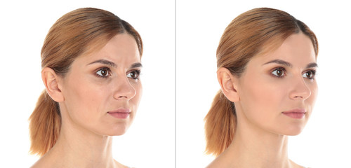 Woman before and after plastic surgery on white background