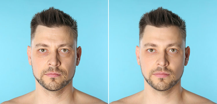 Man before and after plastic surgery on blue background