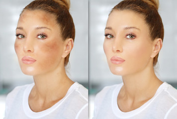 Dark spots, freckles,hyperpigmentation(melasma or chloasma)