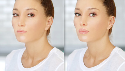 Beauty injections.Concept of rejuvenation.Lip augmentation