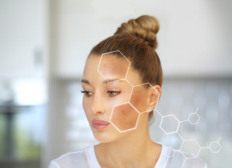 Dark spots, freckles,hyperpigmentation(melasma or chloasma)