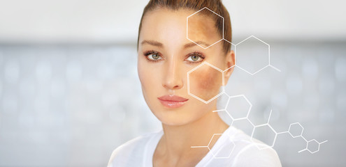 Dark spots, freckles,hyperpigmentation(melasma or chloasma)