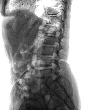 Diagnostic spinal X-ray film of a patient