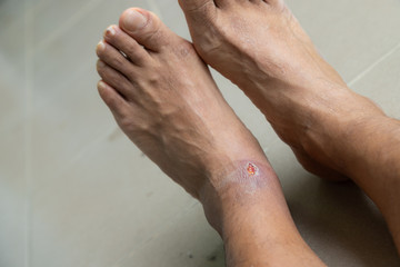 Foot ulcers caused by disease.