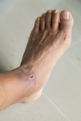 Foot ulcers caused by disease.