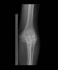 X-ray image of left elbow with wooden splint, anteroposterior (AP) view, showing elbow fracture