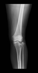 Right knee X-ray image shows tibia and fibula fractures, lateral view