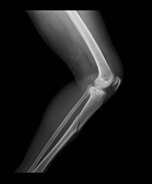 Right knee X-ray image shows tibia and fibula fractures, lateral view