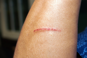 Fototapeta premium Close-up of wound on arm from accident. Scratch on the skin man's from a nail.