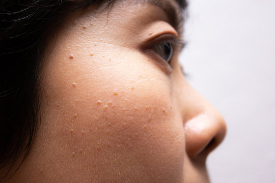 Seborrheic Keratosis on facial skin of asian woman. 