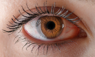 Macro of red woman eye. Bloodshot eye - conjunctivitis or allergic reaction.
