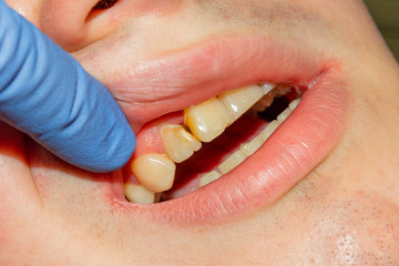 two chewing side teeth of the upper jaw after treatment of caries. Restoration of the chewing surface with a photopolymer filling material using the Rubber Dam system © Сергей Кучугурный