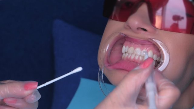 Dentist in sterile gloves applying gel for LED whitening on woman patient's teeth in dentistry, teeth closeup view. Preparing to cosmetic beauty procedure in stomatology clinic.