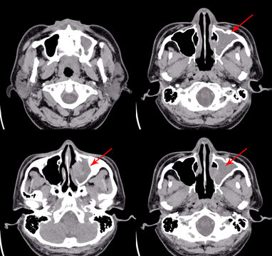 CT Brain And Paranasal Sinuses Impression: Chronic Sinusitis Of Lt Maxillary Sinus.