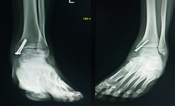 X-ray foot after operation fix screws in medial malleolus tibia.